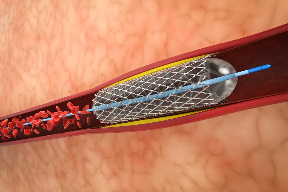Angioplastia coronaria